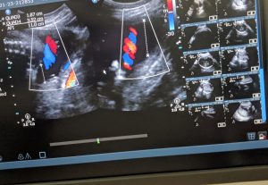 Pregnancy Ultrasound scan