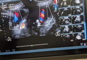 Pregnancy Ultrasound scan