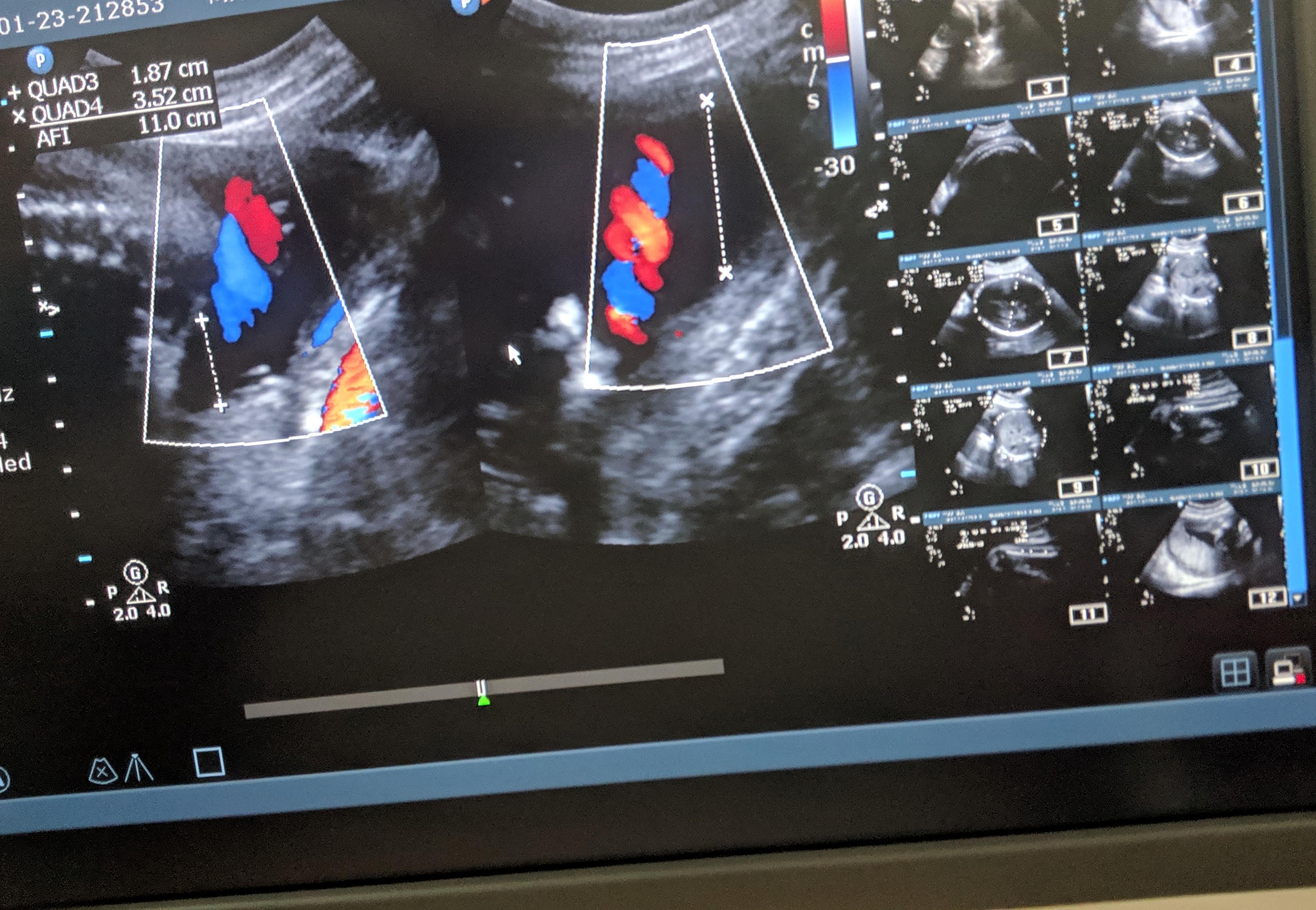 Chorionic villus Sampling Archives PrimedeqBlog