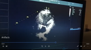 Artifacts in sonography