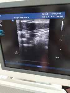ultrasound image dropouts